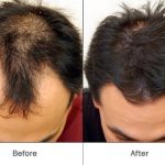 hair re growth with prp 500x500 1
