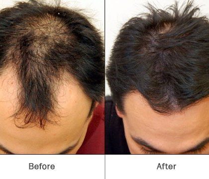 hair re growth with prp 500x500 1